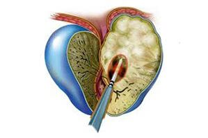 manifestatie van acute prostatitis