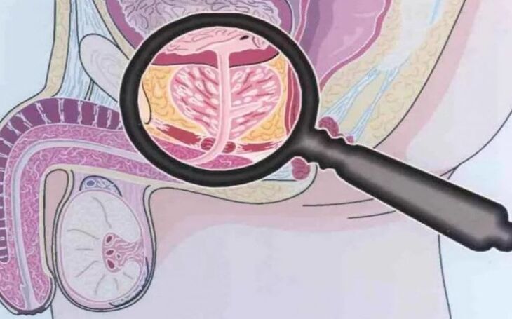 Chronische prostatitis