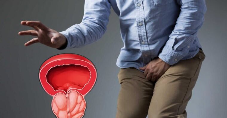 Preventie van prostatitis en prostaatadenoom